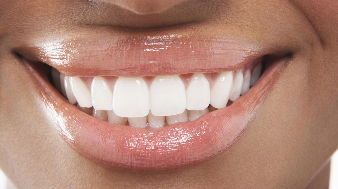 Chesterfield Valley Dental Making your Teeth Whitening Last