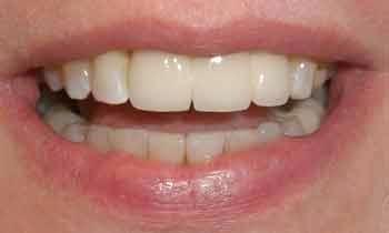 Upper-Veneers-After-Image