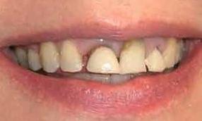 Upper-Veneers-Before-Image