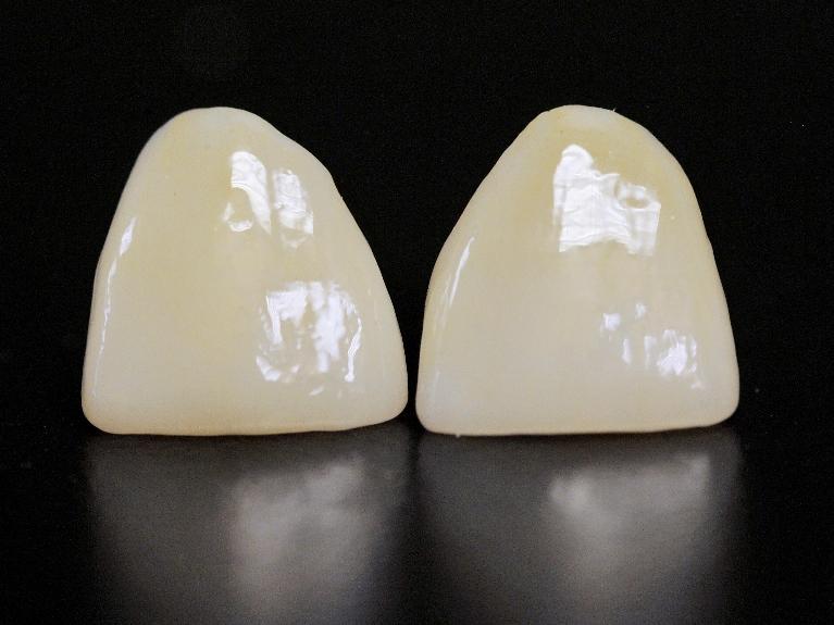 CAD/CAM Restorations | Chesterfield MO Dentist
